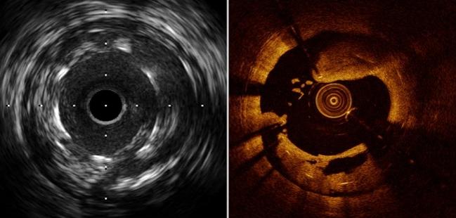 OCT, IVUS Each Boost Long-term Outcomes When Used to Guide PCI, Study Suggests